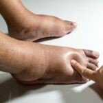 Swollen Legs